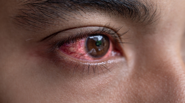 mata-merah-eye-center